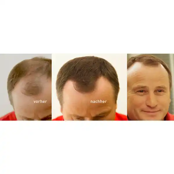 Haarverdichtung mit Schütthaar mittelbraun