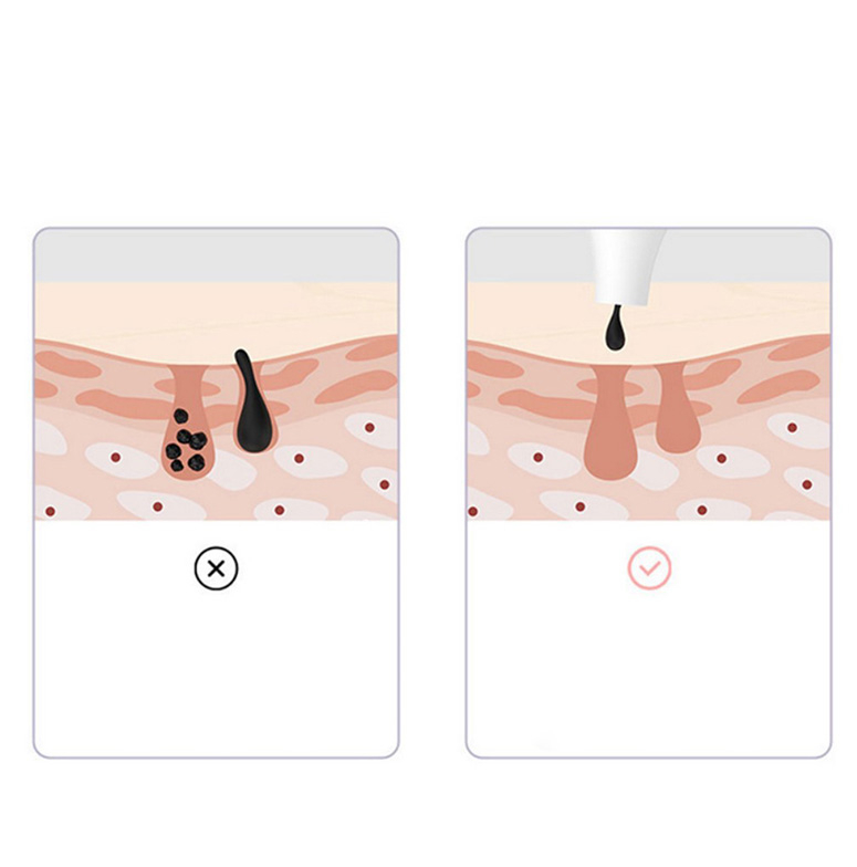 Blackhead Remover Elektrischer USB Mitesserentferner WiFi Gesichtsreiniger mit Kamera für iOS / Android - Weiss