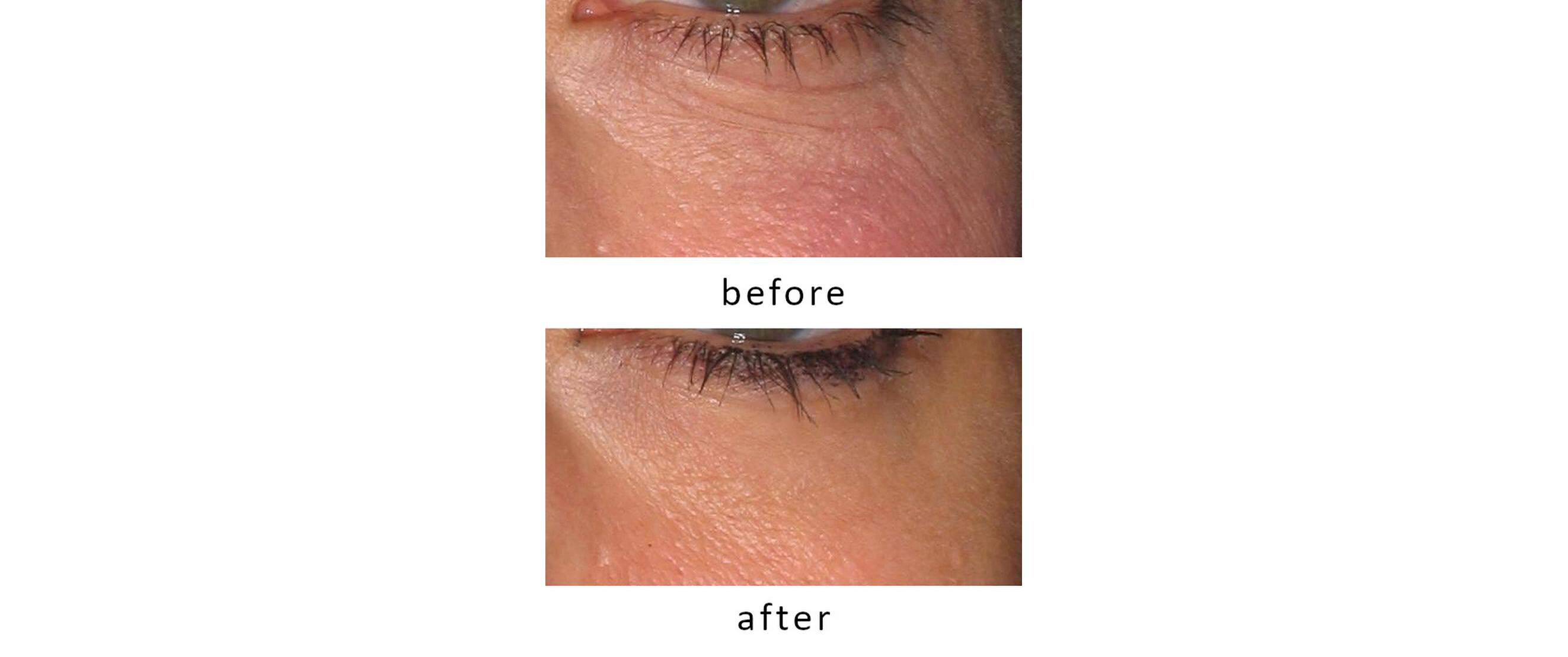 Antiaging-Gerät FaceTite Revive Cordless Weiss<br>Hautverjüngungs Gerät ohne Kabel