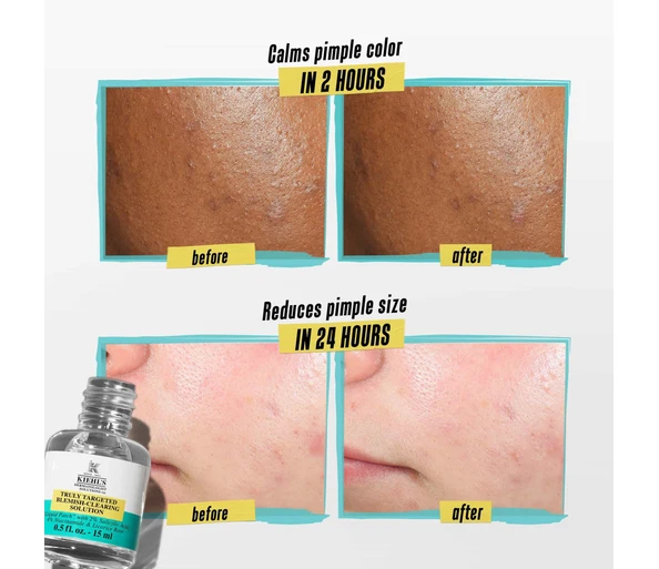 KIEHL'S Truly Targeted Acne-Clearing Solution