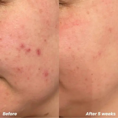BHA/AHA Exfoliant