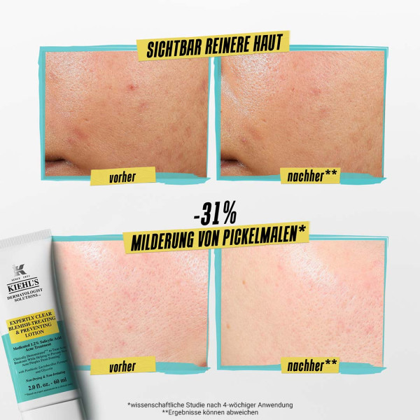 KIEHL'S Acne Treatment 60 ml