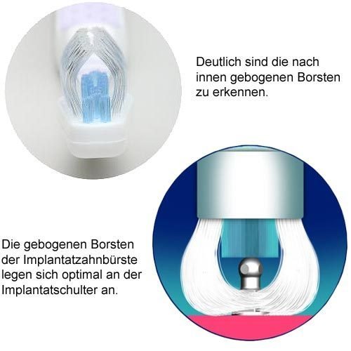 Implantatzahnbürste
