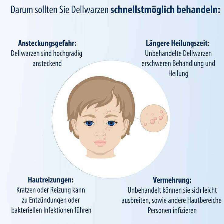 Evolsin Dellwarzen Mittel Lösung, 5 ml