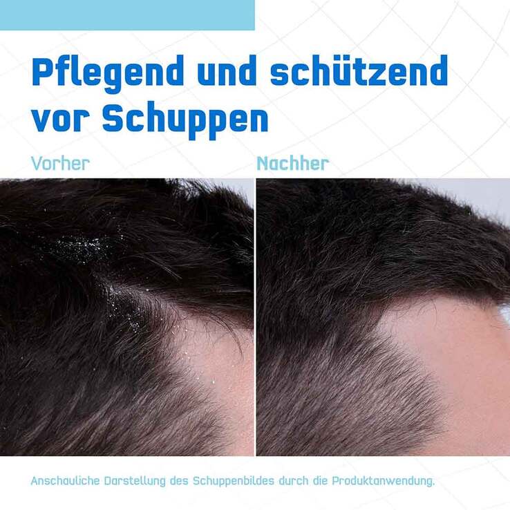 Terzolin Expert Shampoo bei trockener Kopfhaut, 200 ml