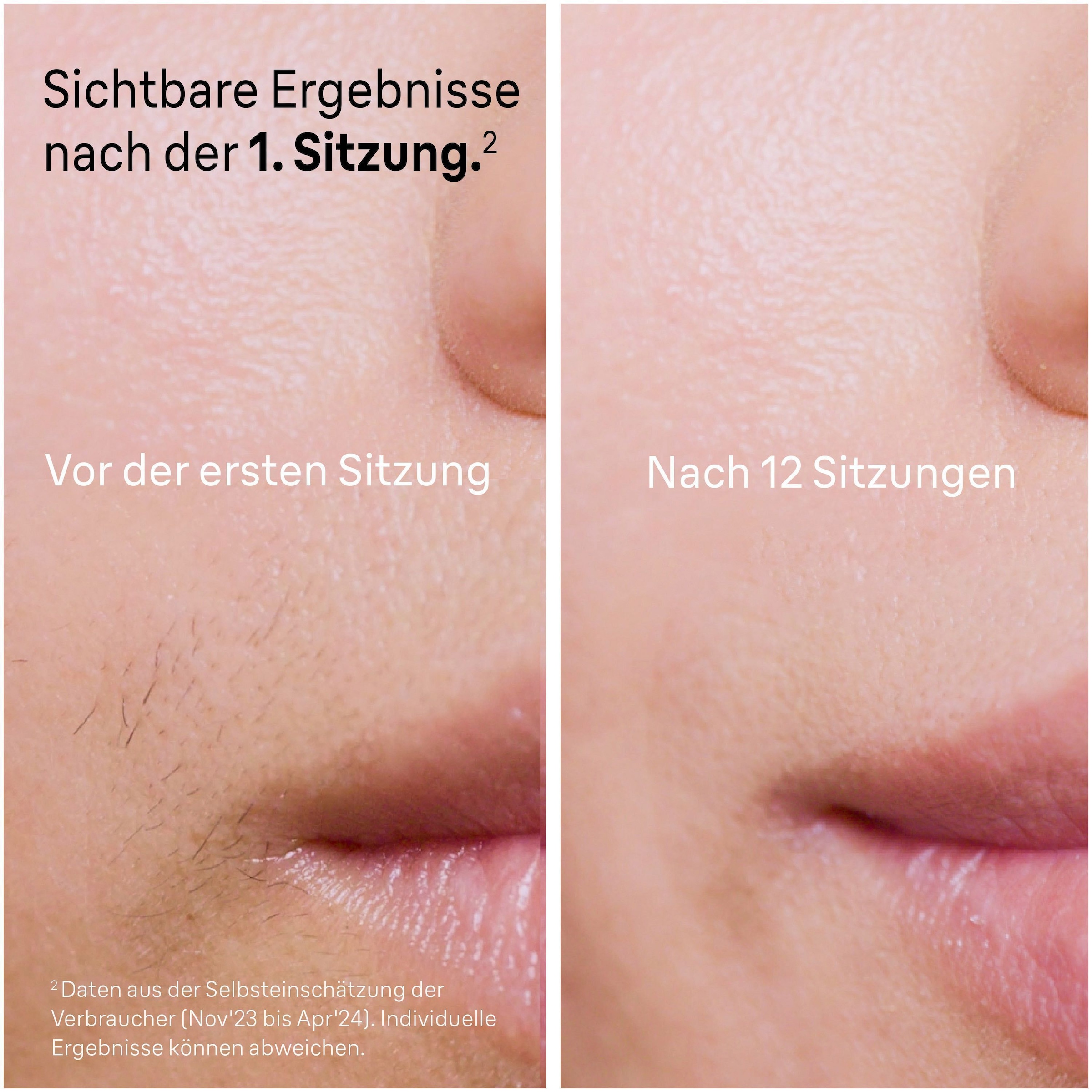 Braun IPL-Haarentferner »Smart IPL Skin i·expert PL7387« 4 Aufsätze für Gesicht & Körper, Venus Rasierer & Aufbewahrungsbox