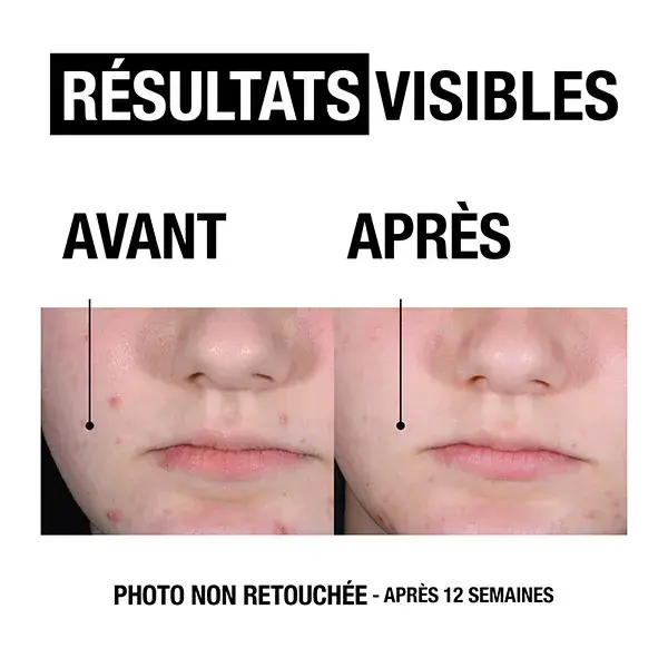 Neutrogena Anti-Boutons + Gel Nettoyant Visage Peaux à Tendance Acnéique 200ml