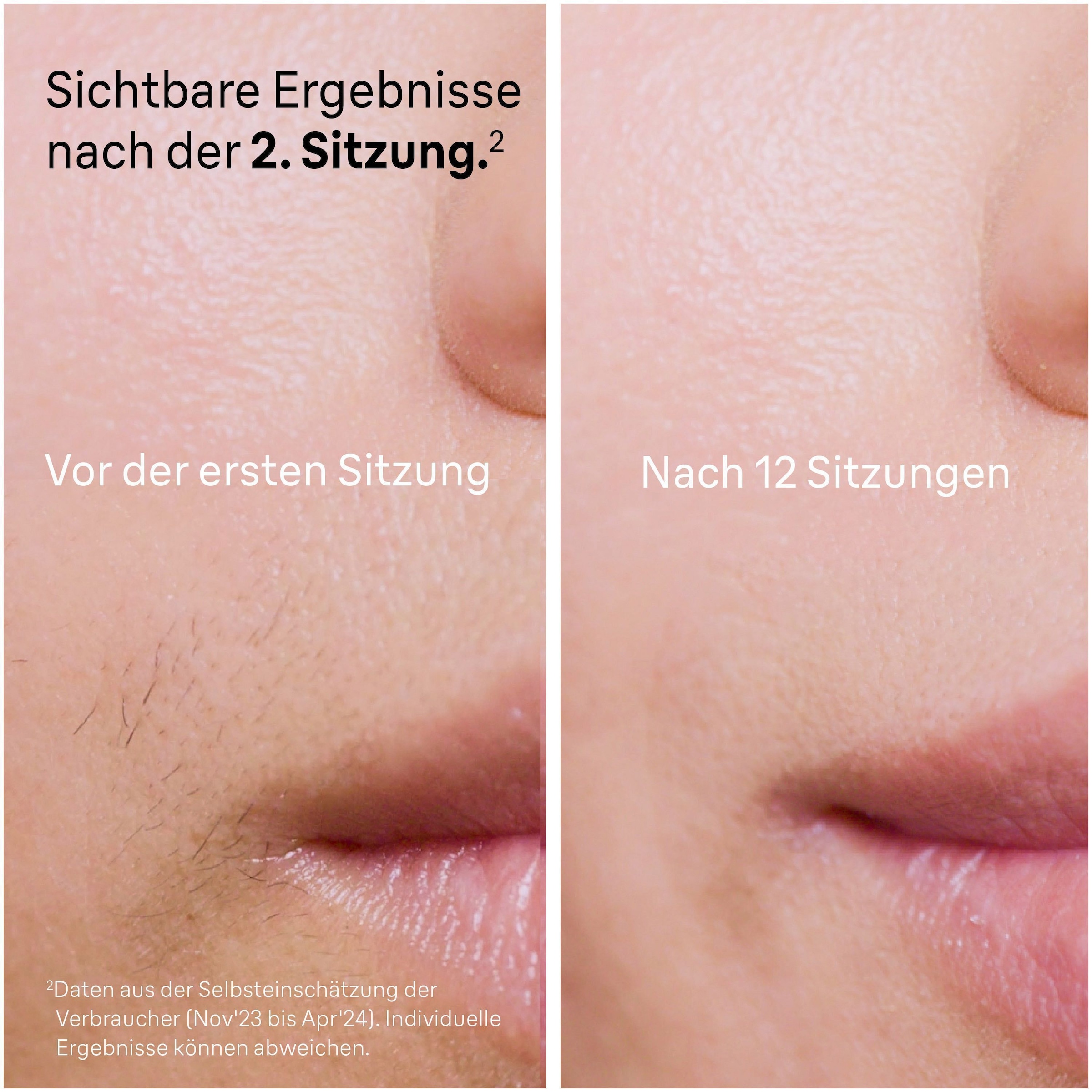 Braun IPL-Haarentferner »Silk-Expert Pro 5 PL5157 IPL« 400.000 Lichtimpulse Skin Pro 2.0 Sensor