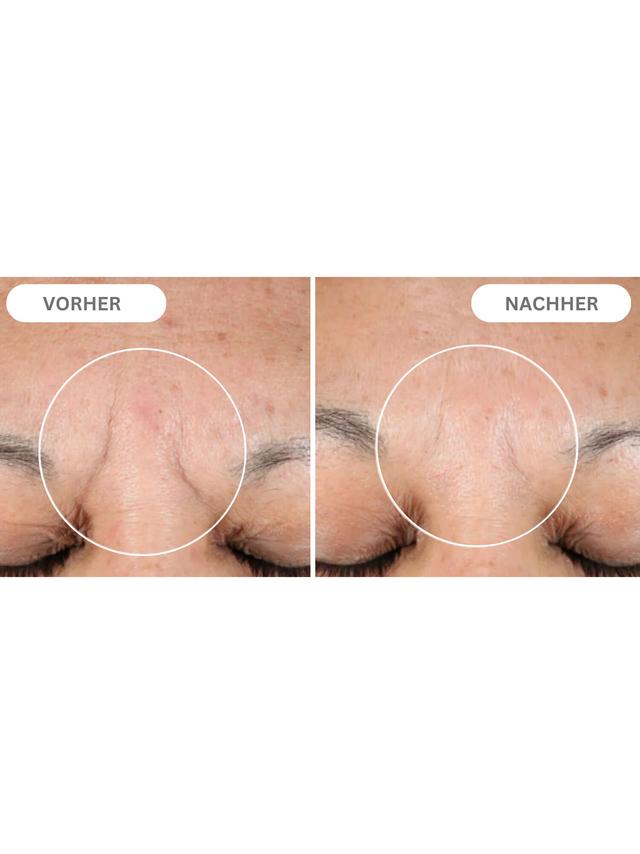 Natural Botulin Serum mit Soforteffekt