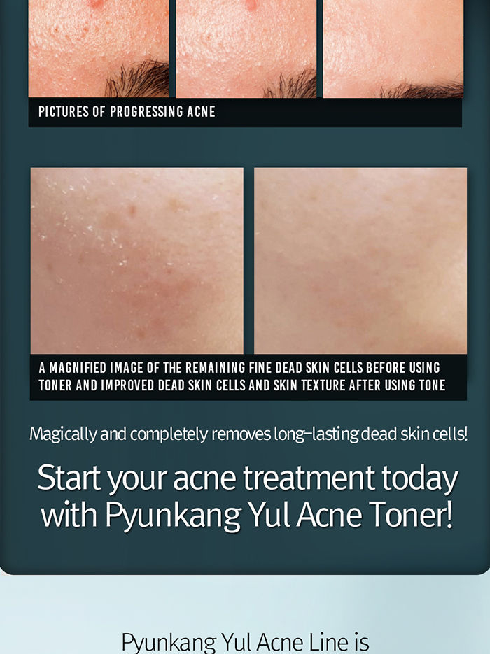 Pyunkang Yul - Acne Toner 150ml