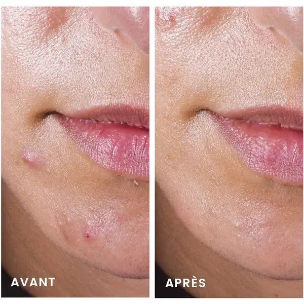 Rotina Anti-Imperfeições Cleanance da Avène