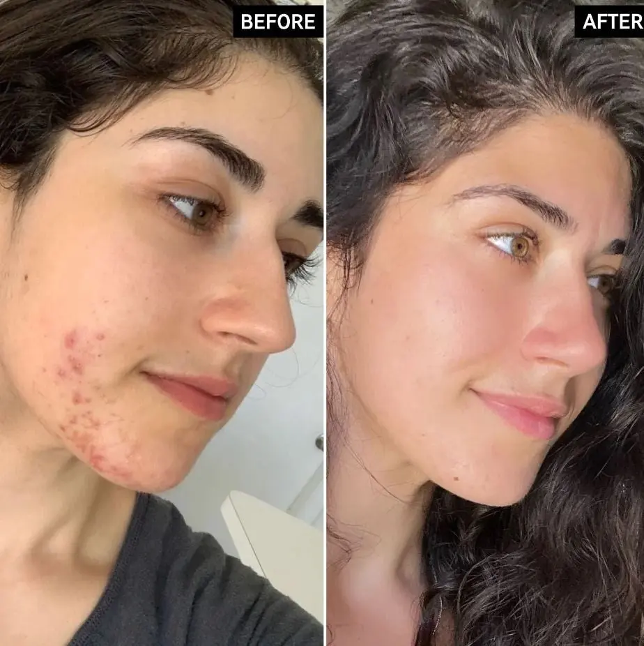Succinic Acid Acne Treatment