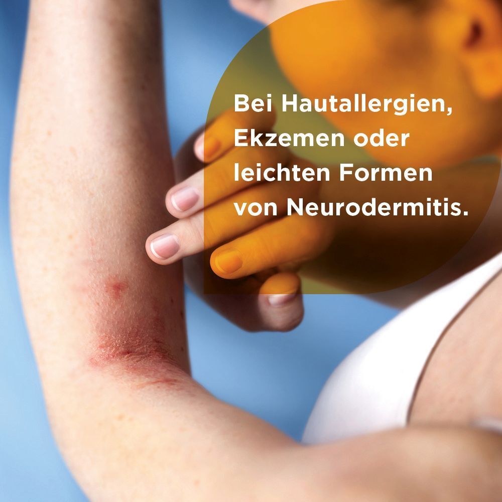 Soventol HydroCort 0,5% bei akuten Hautentzündungen