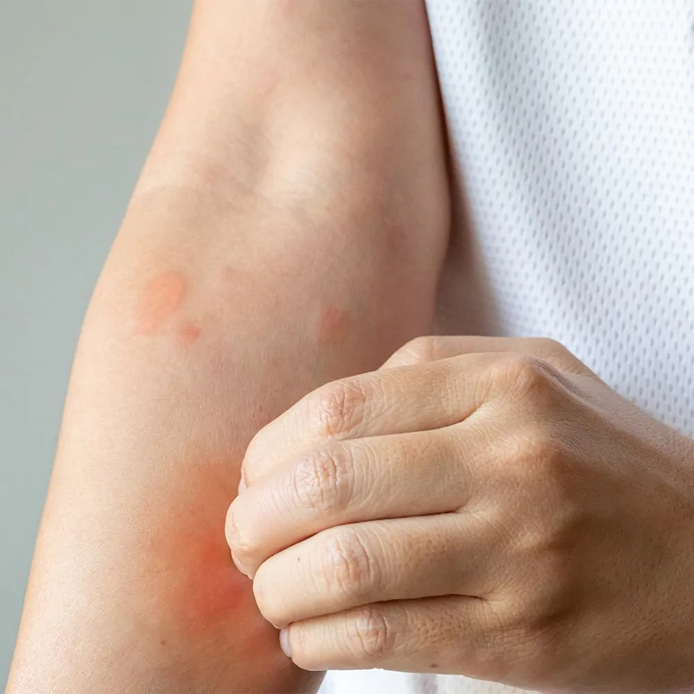 Eczeem Psoriasis Bodylotion 200 ml