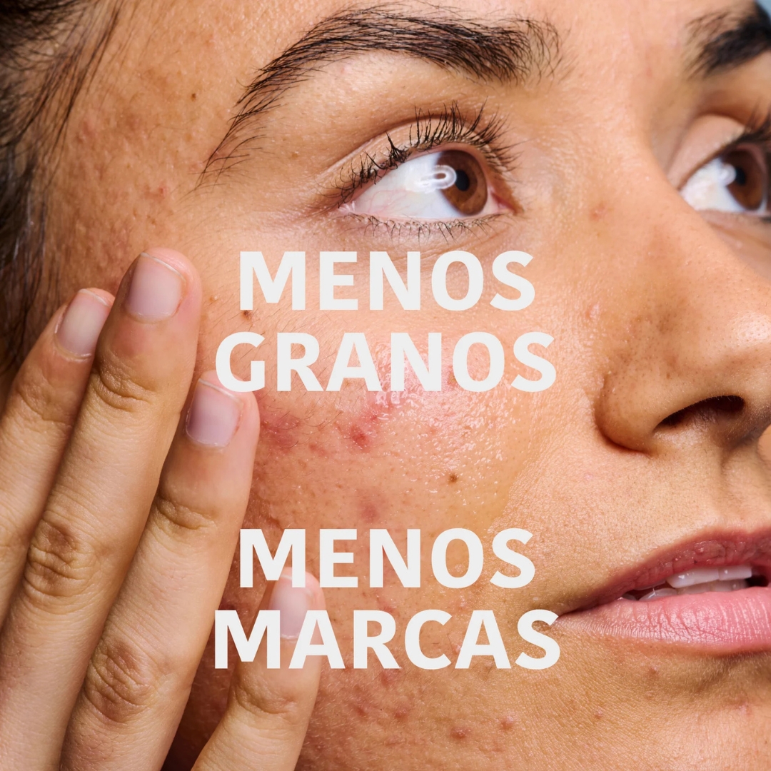 Iroha Nature - *Acne Prone Skin* - Sérum facial Prevent & Correct - Pele com tendência a acne