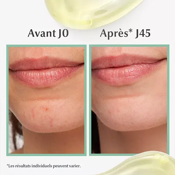 Sérum Tripla Ação Eucerin DermoPure para Pele com Tendência à Acne 40ml