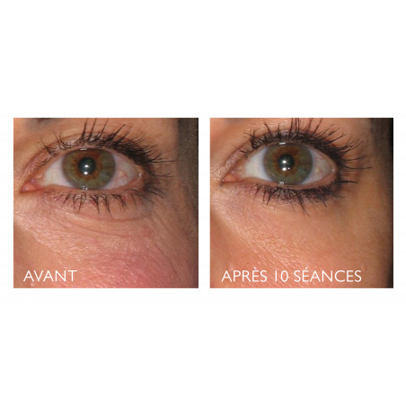 Silk'n Facetite Prestige