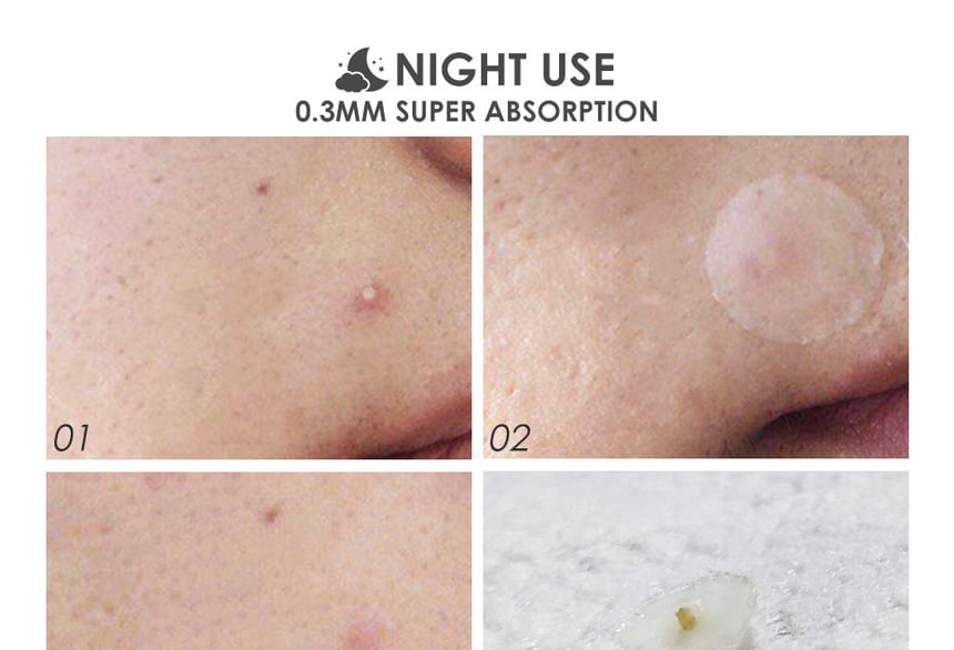 FOCALLURE - Acne Puistjespleister - Dag & Nacht
