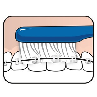 TePe Implantaat/Orthodontie Tandenborstel 1ST