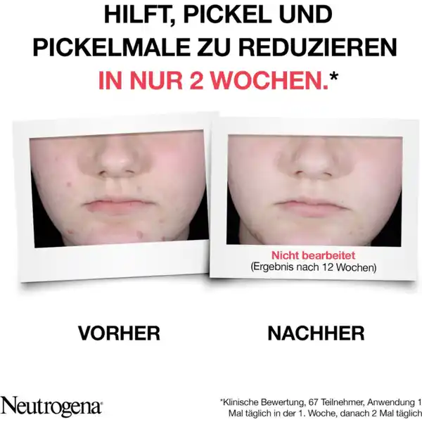 Anti-Pickel+ AHA / PHA / BHA Peeling Serum