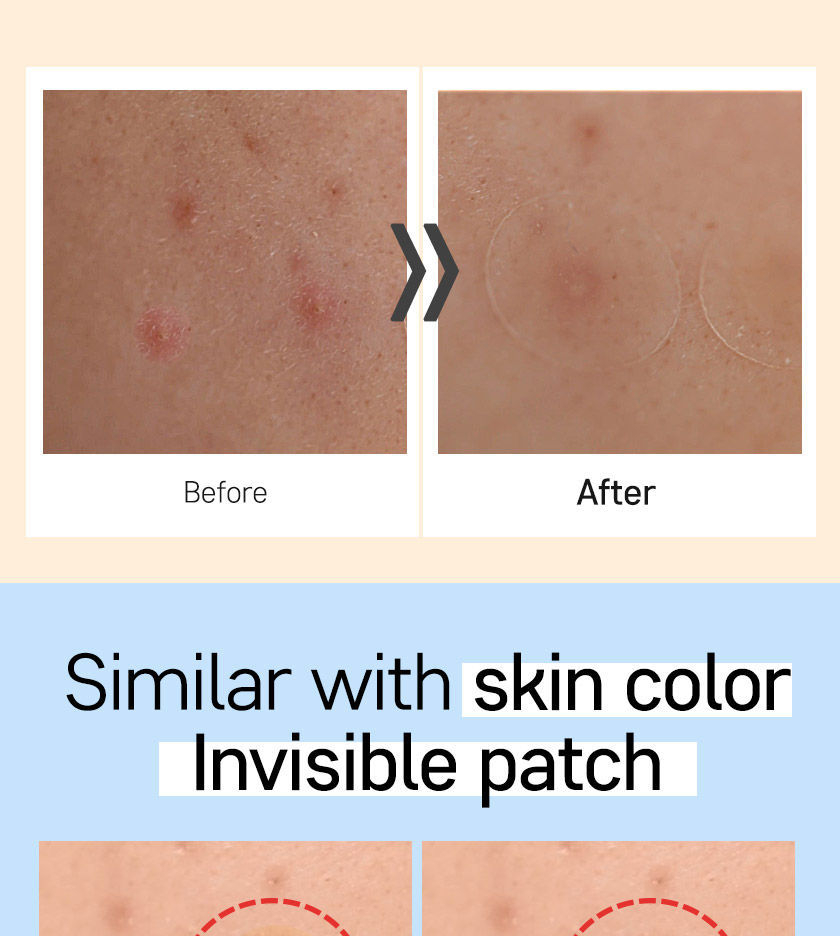 G9SKIN - Zero Solution Spot Cover Patch 108 stuks