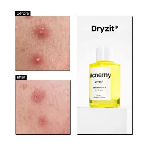 Dryzit Dry Lotion