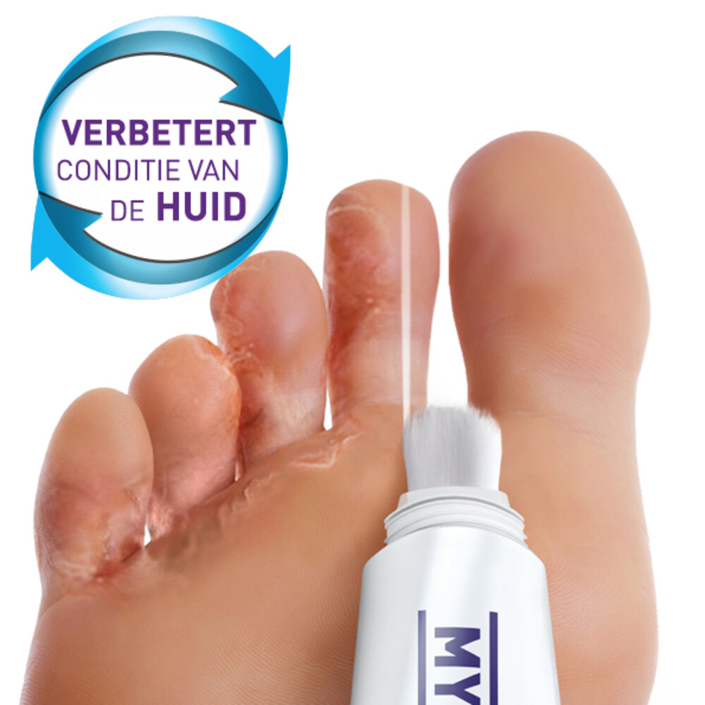 Mycosan Behandelset Gel Voetschimmel15 ml