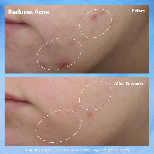 Origins Clear Improvement Acne & Blackhead Clearing Hydrating Moisturizer Lotion, 50 ml
