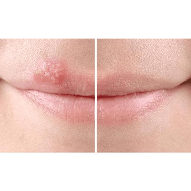 SoreFix Duo Patch voor Koortslip behandeling Ultradun, Transparant, Hypoallergeen 15 stuks