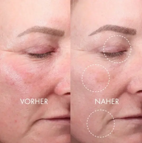 Derma Expert Led Light Treatment