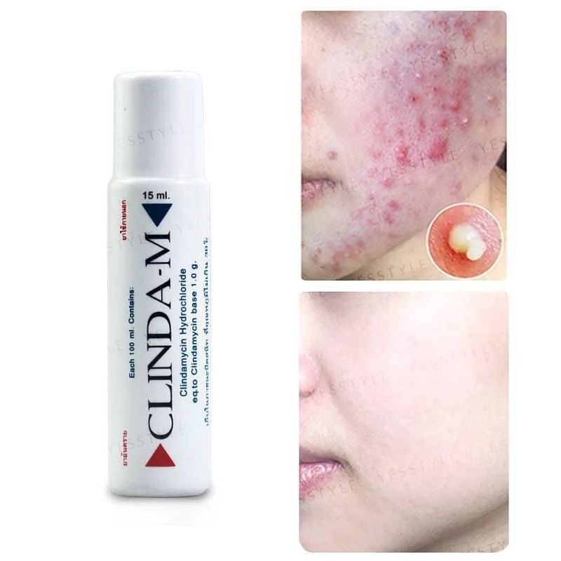 CLINDA - M Acne Water