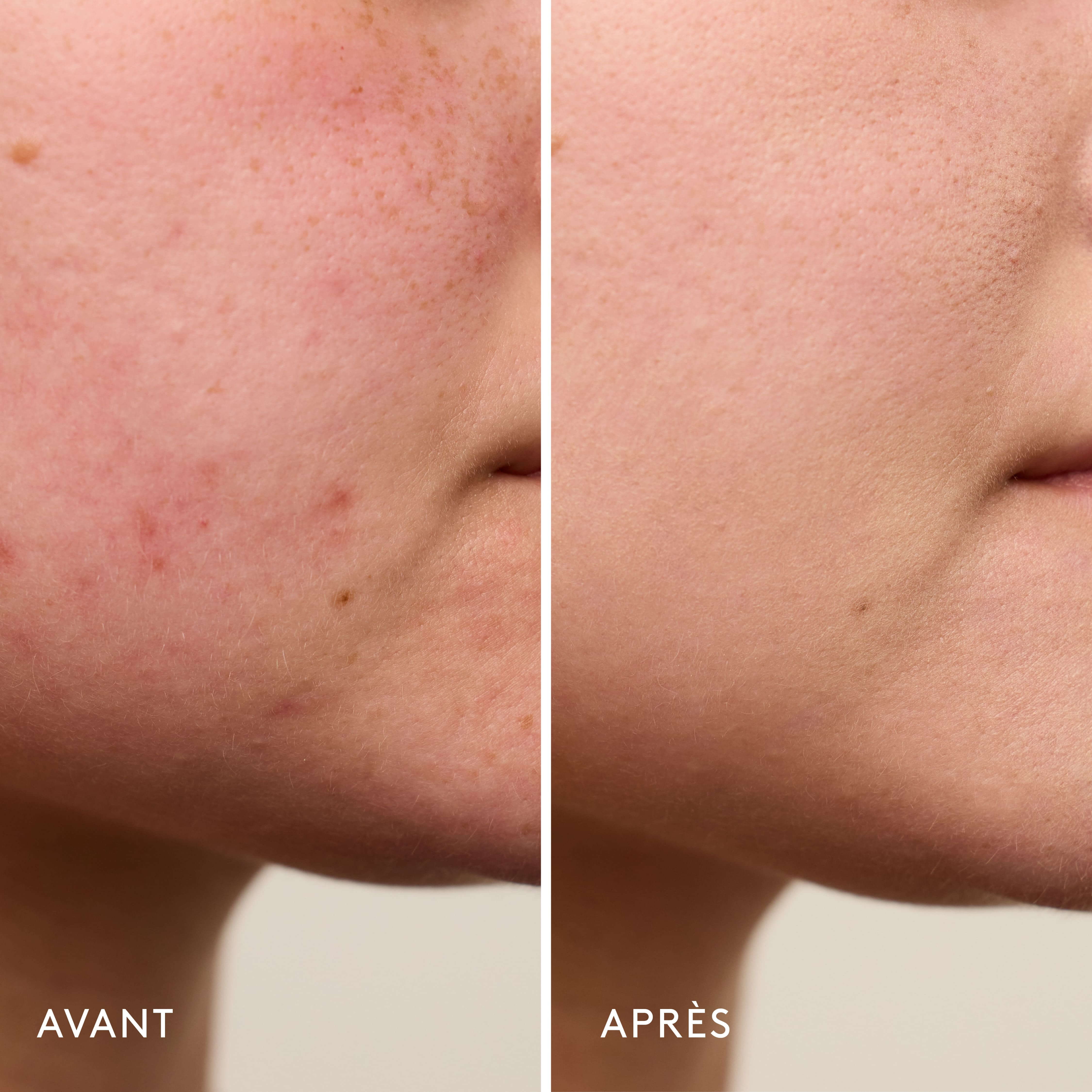 Violette_FR Invisible Bandage Gel Apaisant & Réparateur