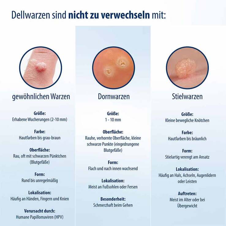 Evolsin Dellwarzen Mittel Lösung, 5 ml