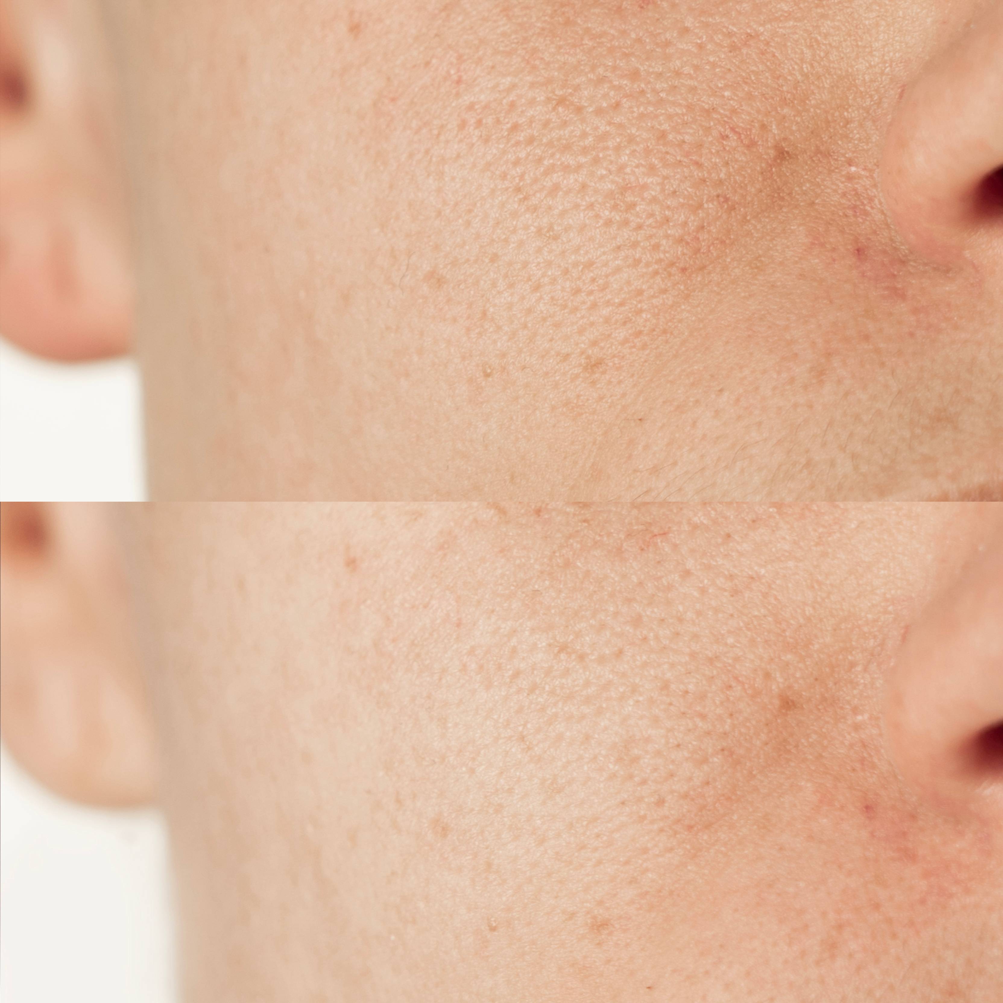 L71 - Masque pores dilatés et points noirs<br>AHA 10 % + PHA 10 %