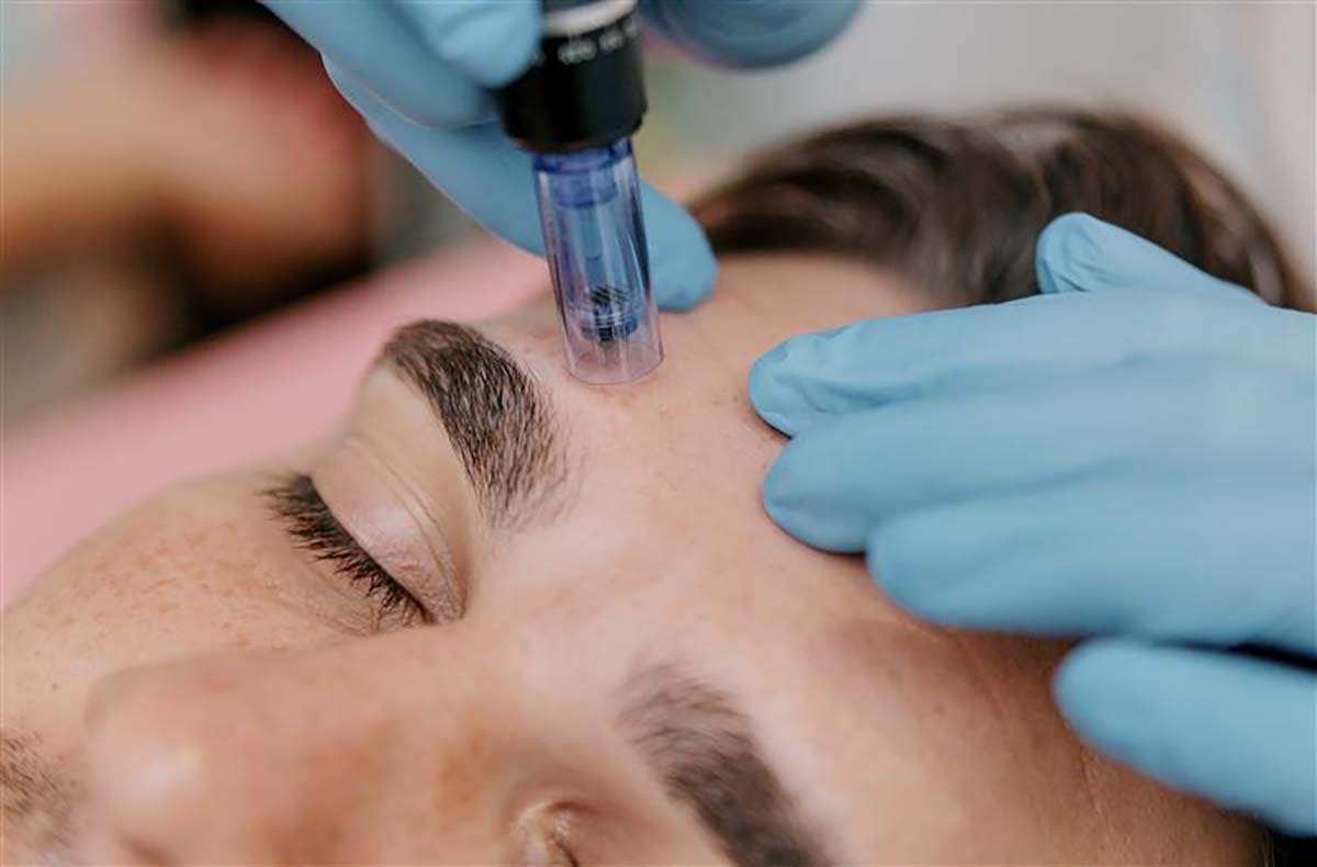 Microneedling Ingolstadt