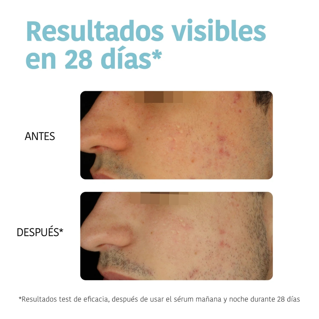 Iroha Nature - *Acne Prone Skin* - Sérum facial Prevent & Correct - Pele com tendência a acne