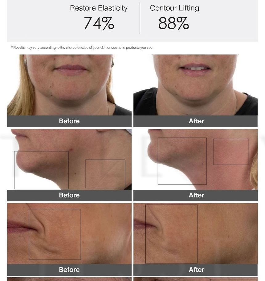 LIFETRONS - Ultra Facial Lift met microstromen en lichttherapie