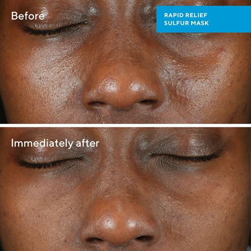 Murad Rapid Relief Acne Sulfur Mask, 75 ml