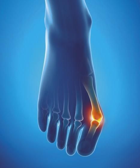 Epitact Hallux Valgus Beschermer