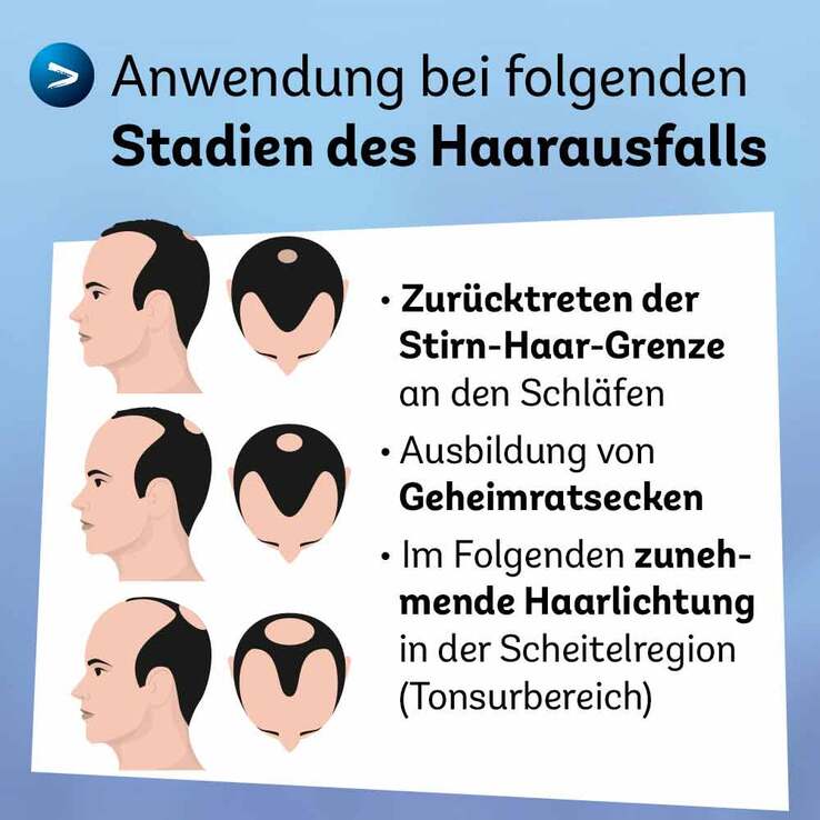 Minoxidil Dexcel 50 mg / ml Spray z.Anw.a.d.Kopfhaut, 60 ml