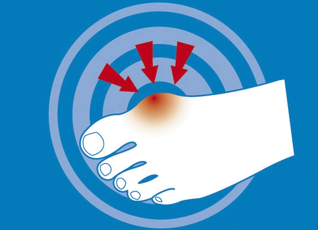 epitact Epithelium 26® Hallux valgus-Schutz