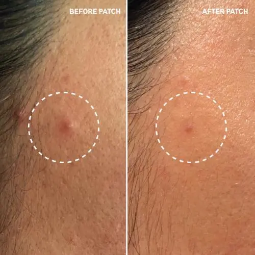 Hydrocolloid Invisible Pimple Patches