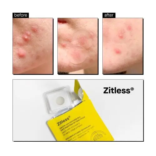 Zitless Microdart Pimple Patches