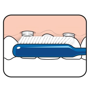 TePe Implantaat/Orthodontie Tandenborstel 1ST