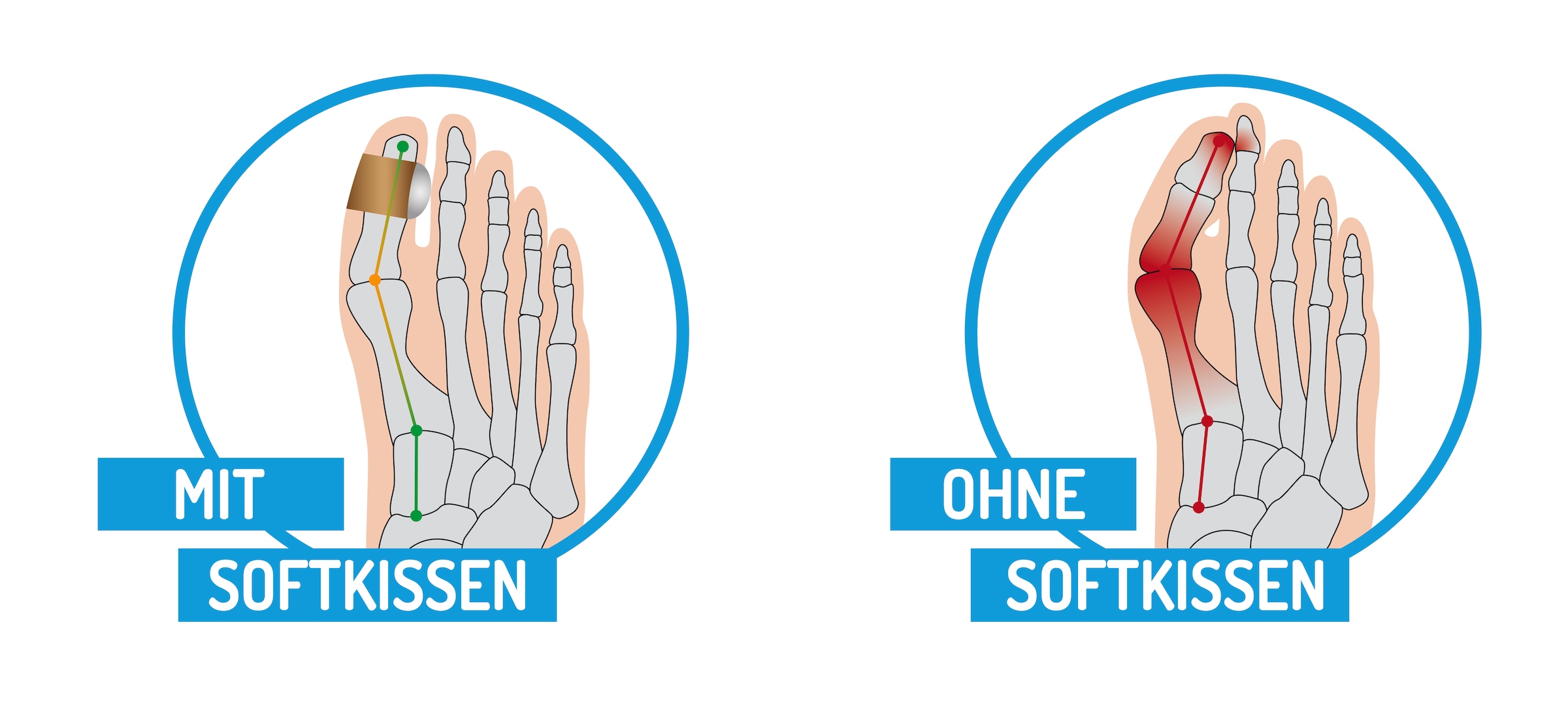 Fussgut Hallux-Bandage »Softkissen mit Fixierband, verhindert Reiben« Druckentlastung bei Hühneraugen, Schwielen, Entlastung Hallux Valgus