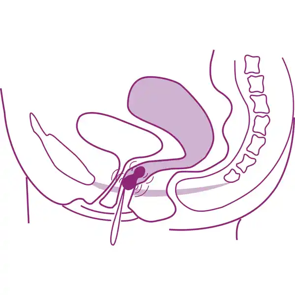 Beckenboden-Trainingshilfe Phase II