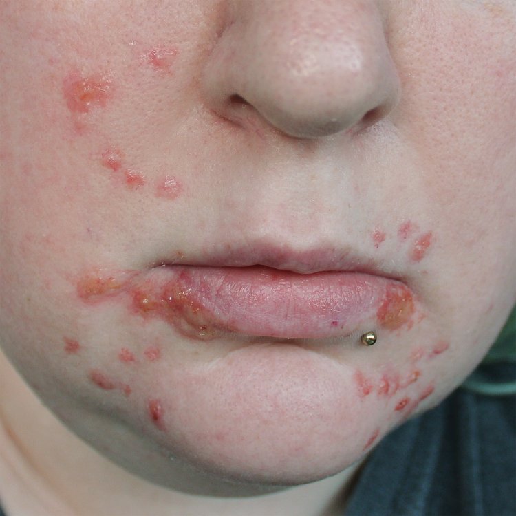JessFX Moulds - Acne