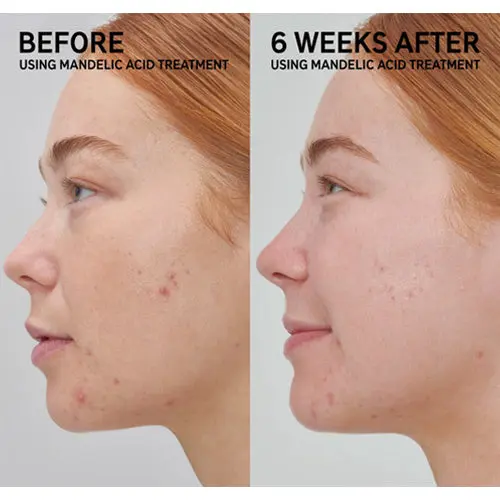 Mandelic Acid Treatment