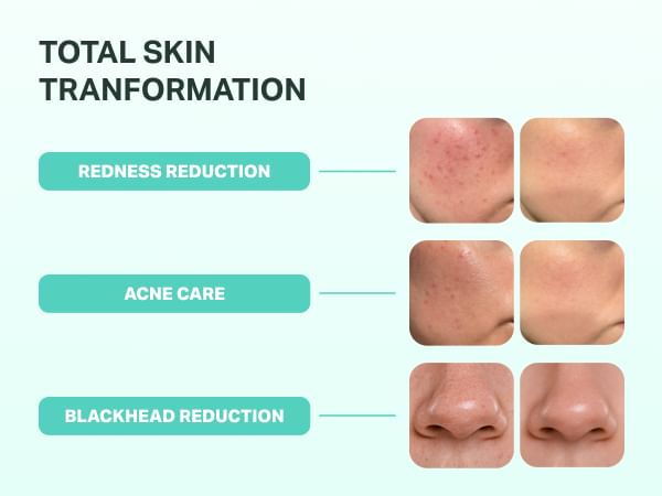 BRENG GROEN - Zinc Teca Blemish Serum