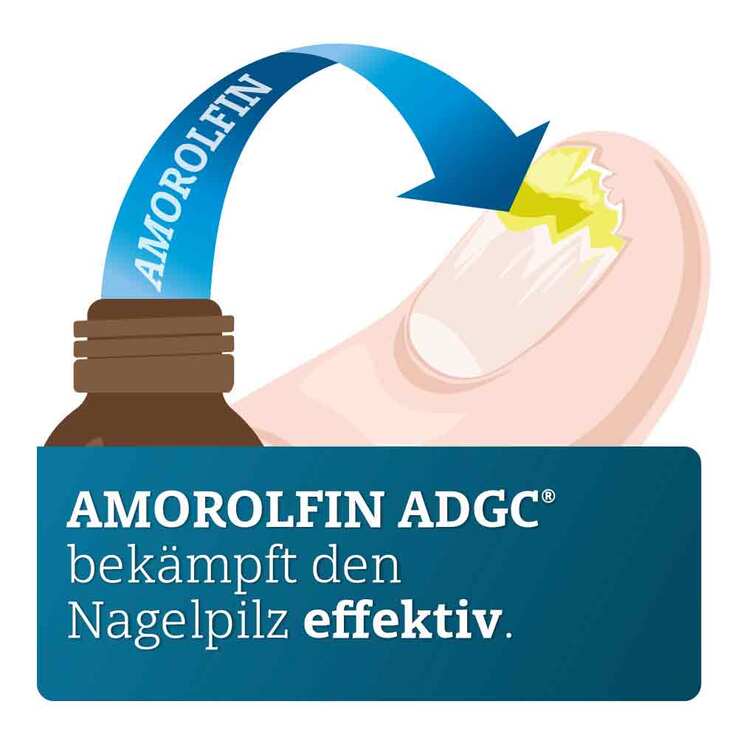 Amorolfin ADGC 50 mg / ml wirkstoffhalt.Nagellack, 5 ml